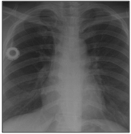 케모포트 삽입된 흉부 X-ray사진